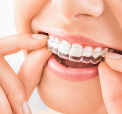 Invisalign shutterstock_739359838.jpg