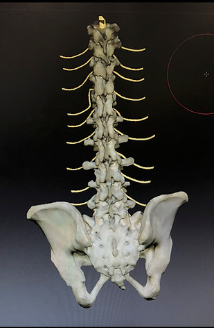 lumbar puncture.jpg