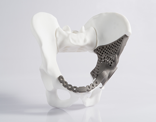 Personalized implants: 3D printed medical devices