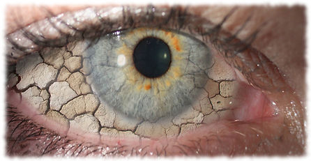 Sindrome de ojo seco en Guayaquil