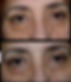XANTELASMA ANTES Y DESPUES.png
