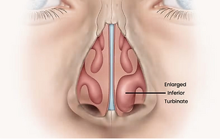 Nose Blockage