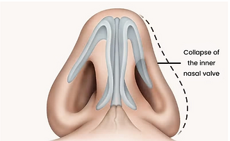 Nose Blockage