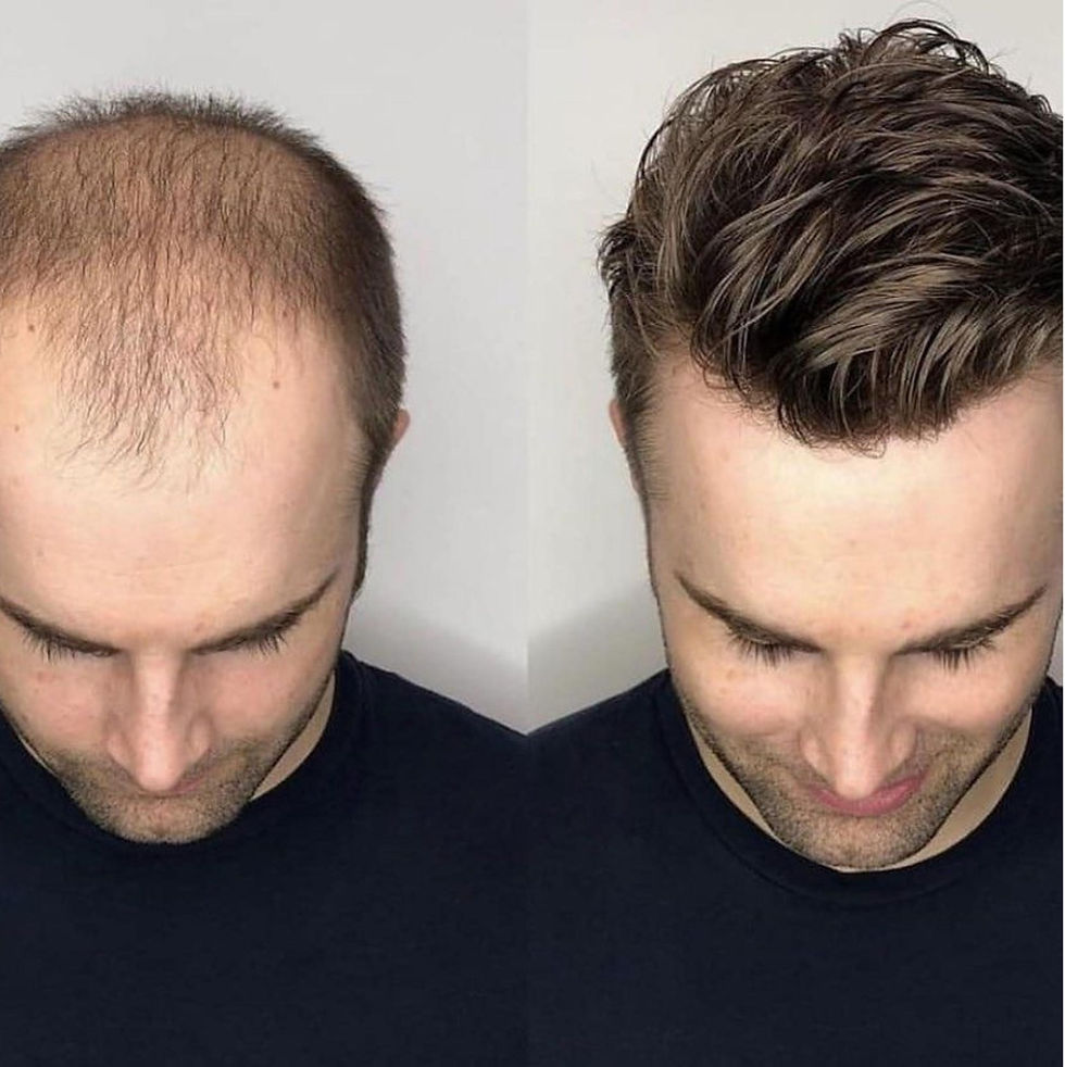 Hair Replacement Singapore