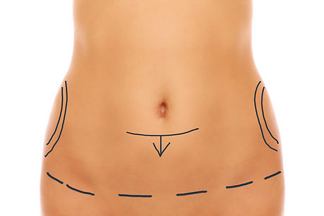 abdominoplastyka-1 (1).jpg