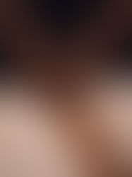 Why Lymphatic Drainage Is Essential After Surgery