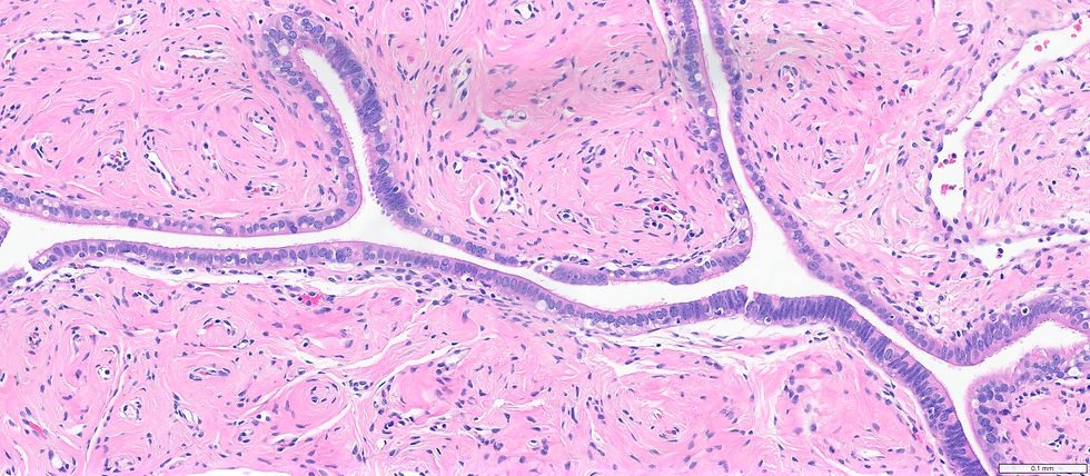 Benign unremarkable tube but the right corner starting to look like bluer (high N:C ratio)