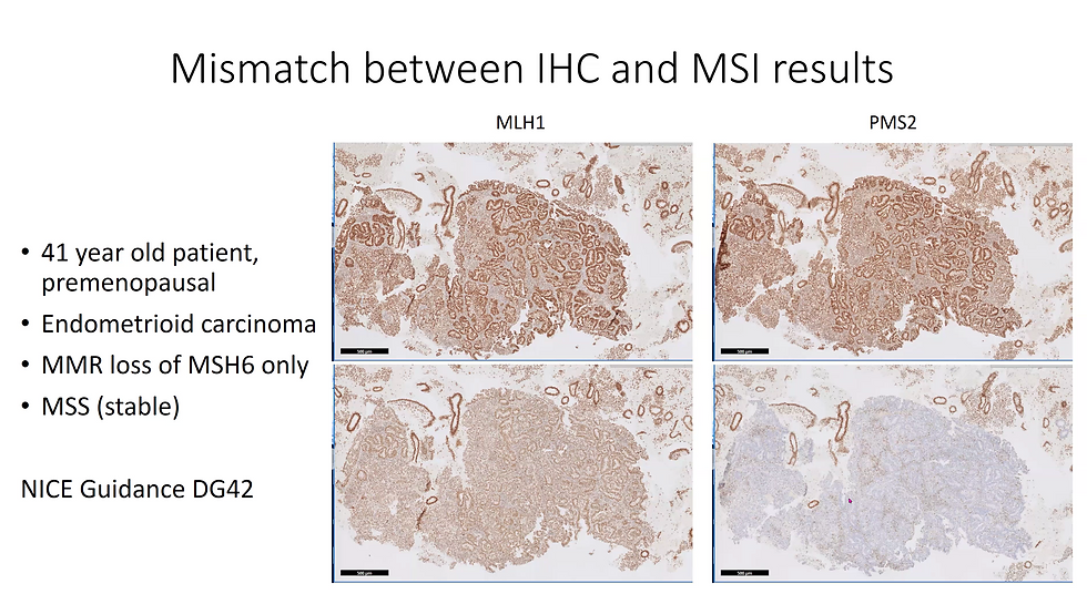 In this case, germline testing should be performed. despite PCR showed MSS. You can see weak staining of MSH2
