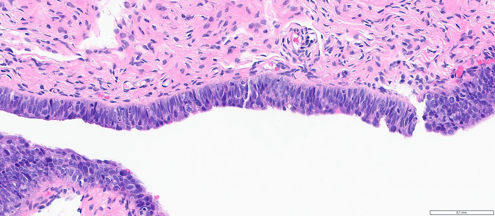 P53 diffusely nuclear positive >80%