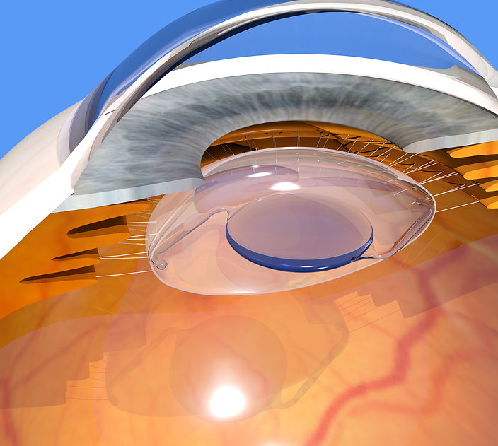 หมอตาเชียงใหม่ จักษุแพทย์เชียงใหม่ ต้อกระจก เลนส์แก้วตาเทียม intraocular lens implant cataract eye doctor ophthalmologist Chiang Mai Hospital