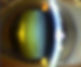 หมอตาเชียงใหม่ จักษุแพทย์เชียงใหม่ ต้อกระจก เลนส์แก้วตาเทียม intraocular lens implant cataract eye doctor ophthalmologist Chiang Mai Hospital