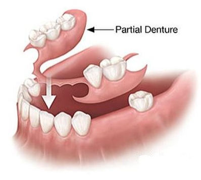 partial-denture