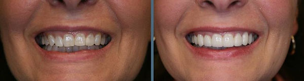 teeth porcelain veneers