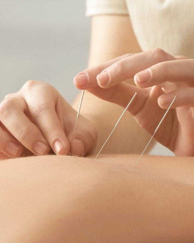 Acupuncture Session
