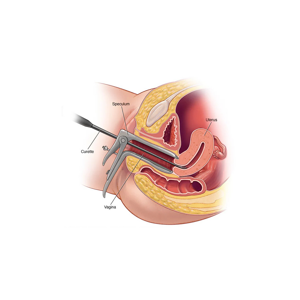 Dilation and curettage (D&C).png