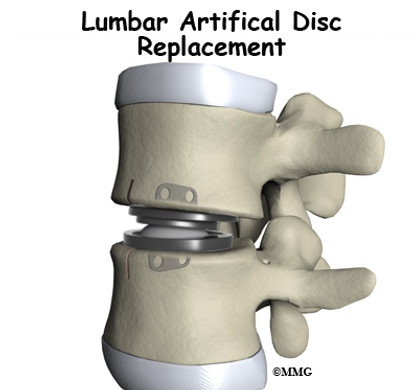 lumbar_ADR_intro01.jpg