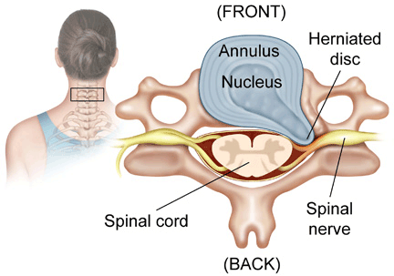 Cervical_Disc_Herniation_and_Radiculopathy.gif