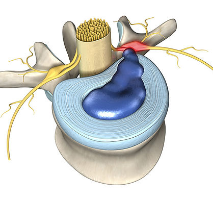radiculopathy_for-web.jpg