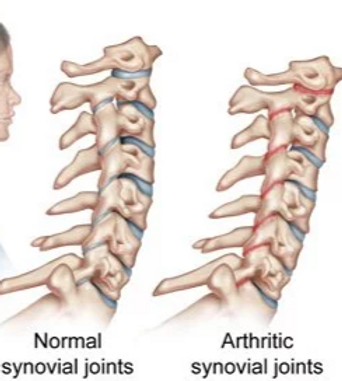 rheumatoid_arthritis_edited.png