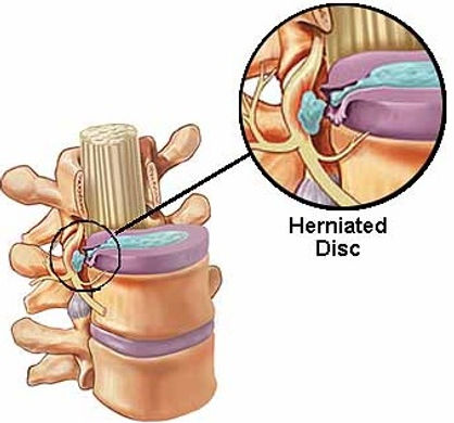 Lumbar-Microdiscectomy-1.jpg