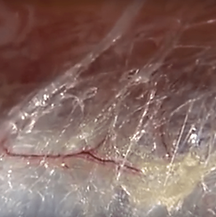 fibromyalji- miyofasyal ağrı