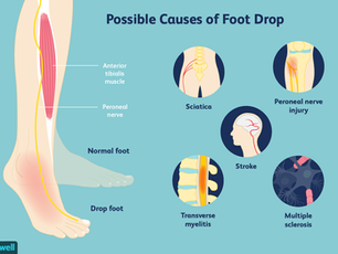 What nerve injury causes foot drop?  