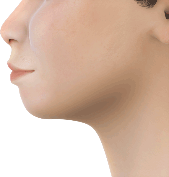 From protrusive dental profile to the ideal