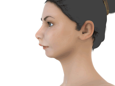 Animation of a surgical treatment - mandibular advancement