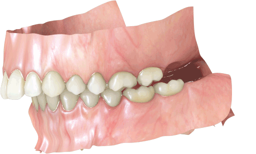 Treatment simulation - correction of dental overjet