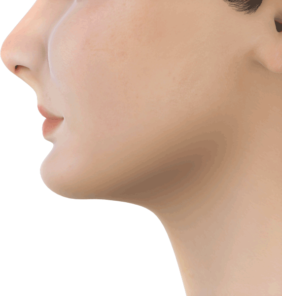 From retuded facial profile to the ideal