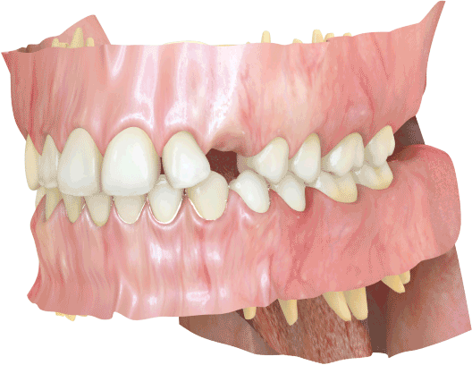 Treatment simulation - correction of an impacted canine