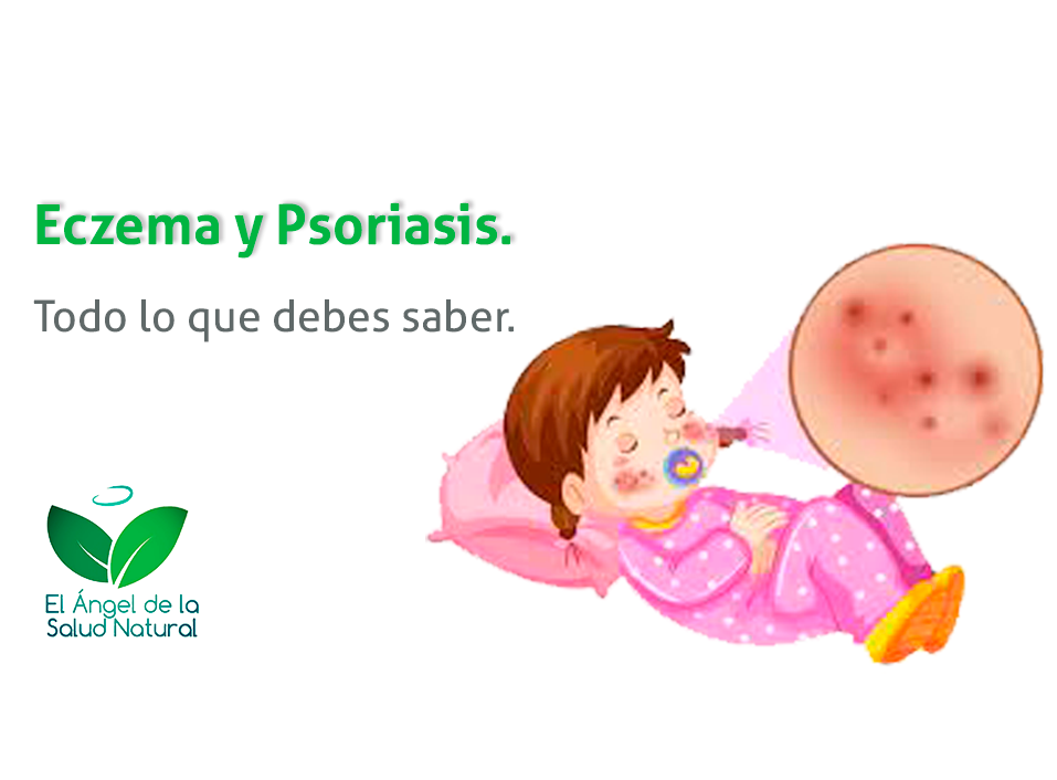 Eczema y psoriasis todo lo que debes saber