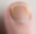 Close-up of a human toenail with a thick, cracked surface. The skin around is pinkish. The background is white, highlighting the nail's texture.