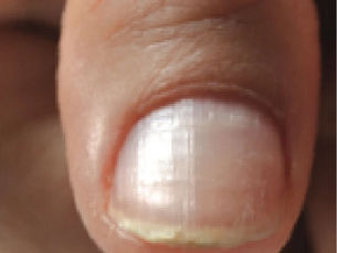 Understanding Nail Peeling: Causes and Solutions