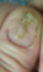 Close-up of a damaged, discolored toenail with peeling skin. The nail is rough-textured, showing signs of possible fungal infection.