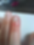 Close-up of a finger with a swollen, red area near the nail.
