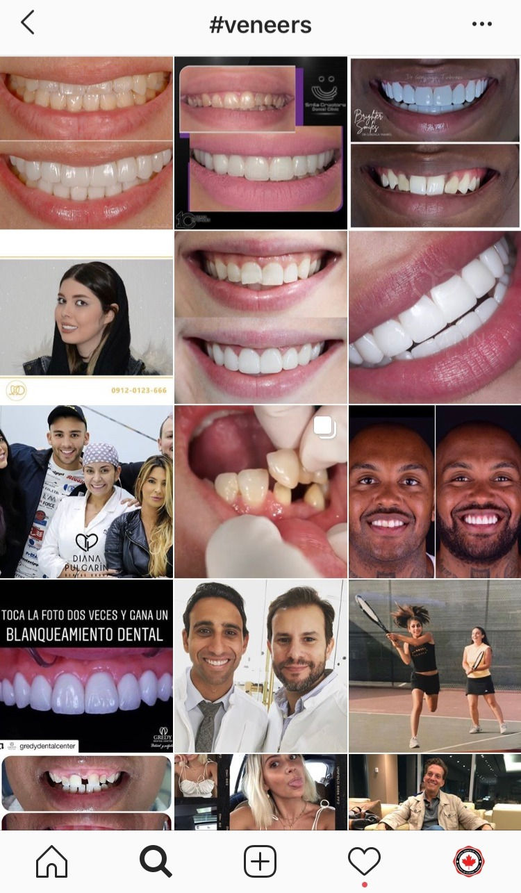 veneers-instagram-feed-social-media-teeth-dentist
