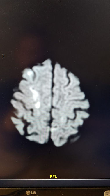 MRI ischemic stroke.jpg
