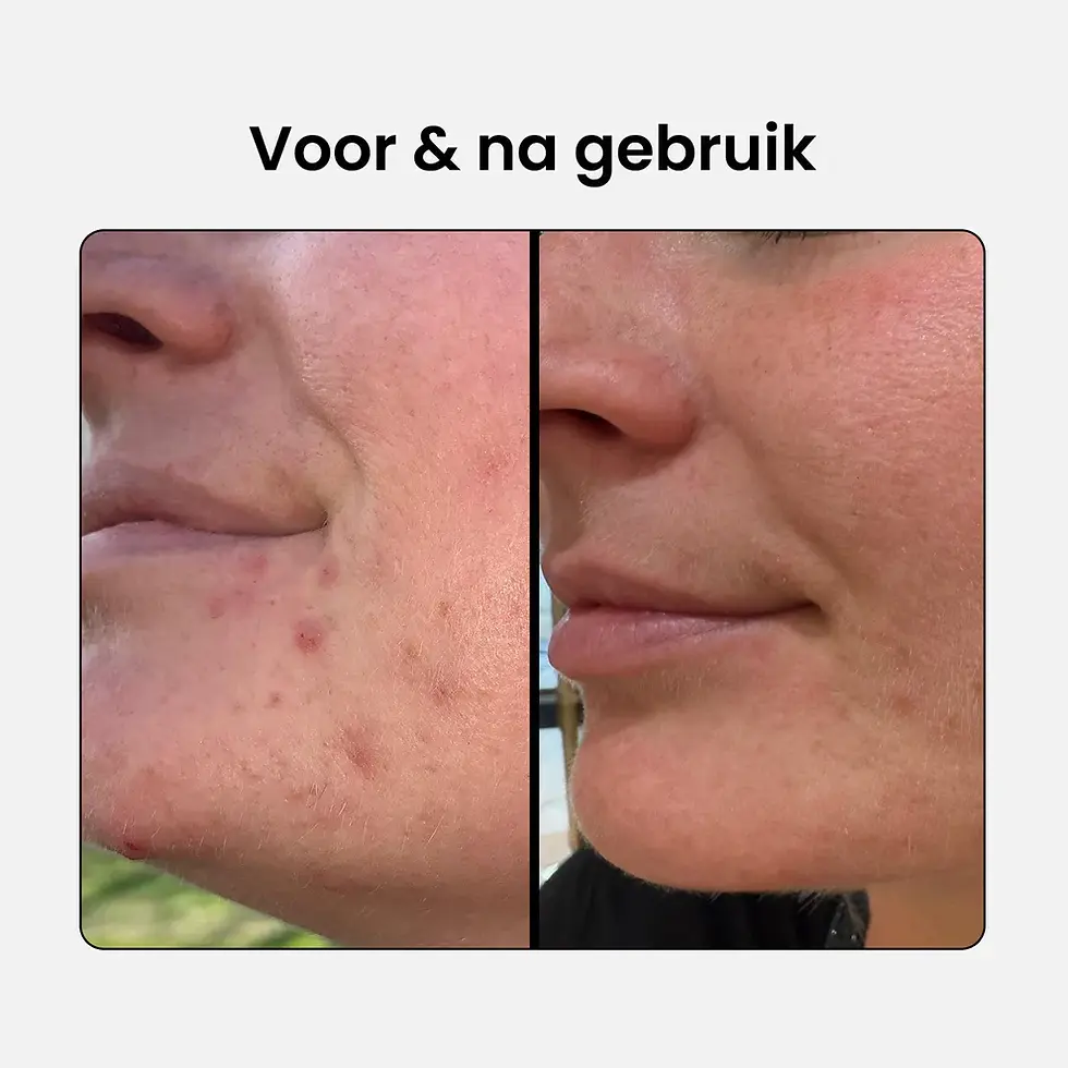 Thumbnail: 2% BHA Lotion Exfoliant  Diepe exfoliatie tegen onzuiverheden