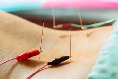 Elctroacupuncture.jpeg