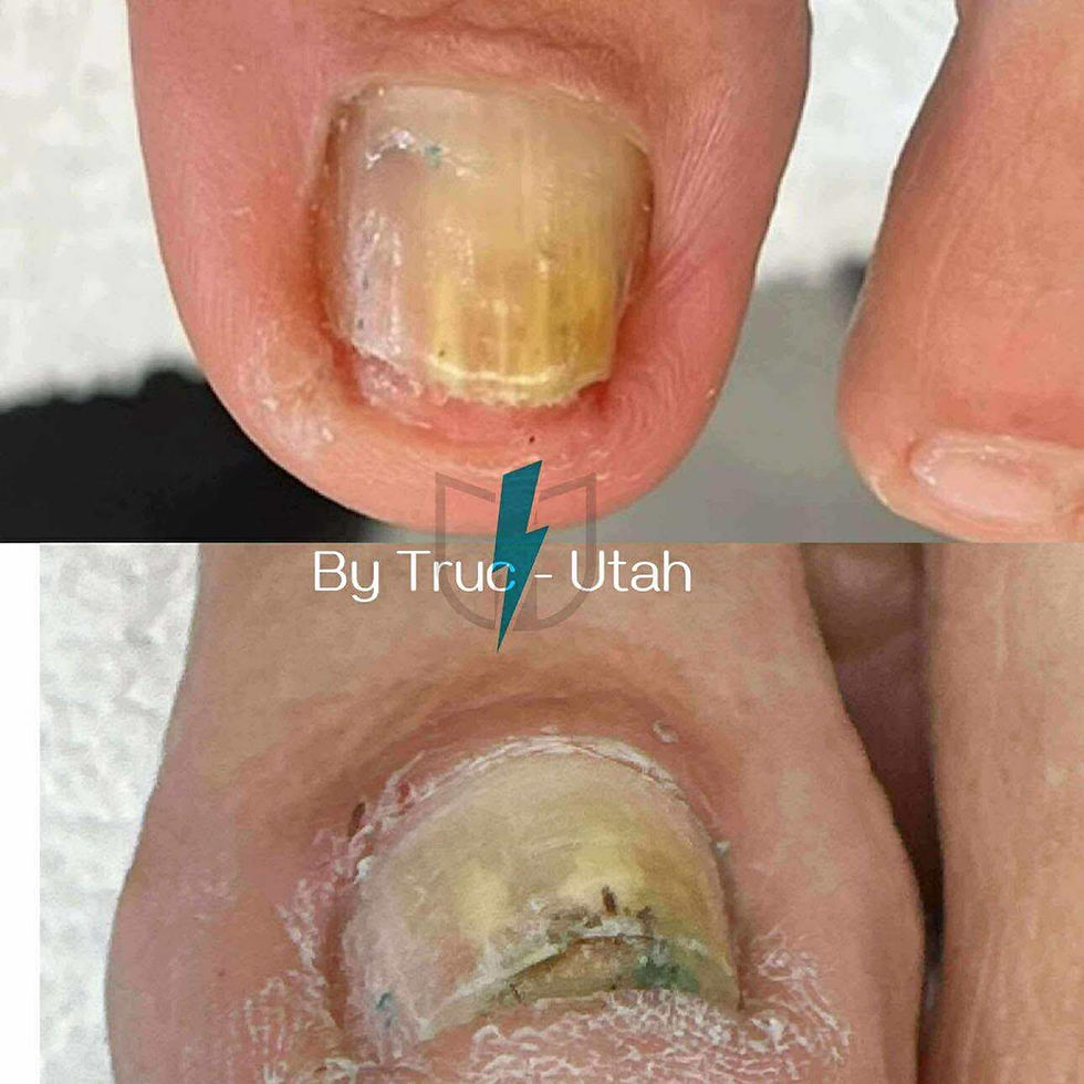 Nail Fungus Treatment