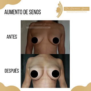 Reducción de busto (10).png