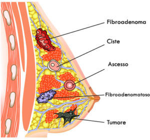 noduli-seno-300x281.jpg