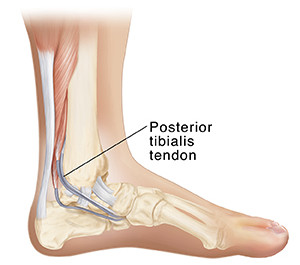 Posterior tibialis tendonitis