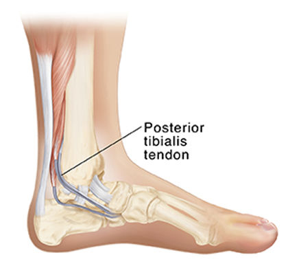 Posterior tibialis tendon dysfunction