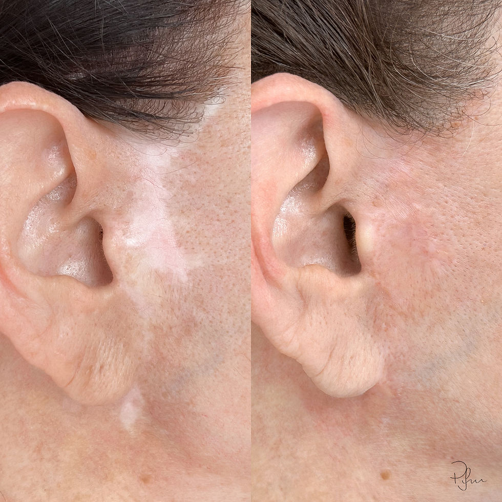 Scar color equalization before and after — skin restoration results at Iwama Enhancement, Boca Raton FL