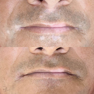 Vitiligo Camouflage - Priscila Iwama