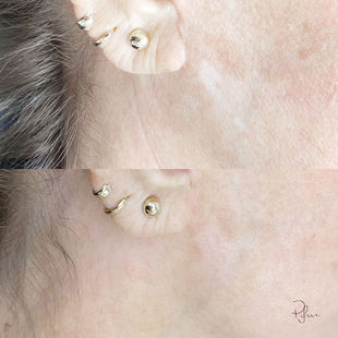 Hypopigmentation Camouflage - Priscila Iwama