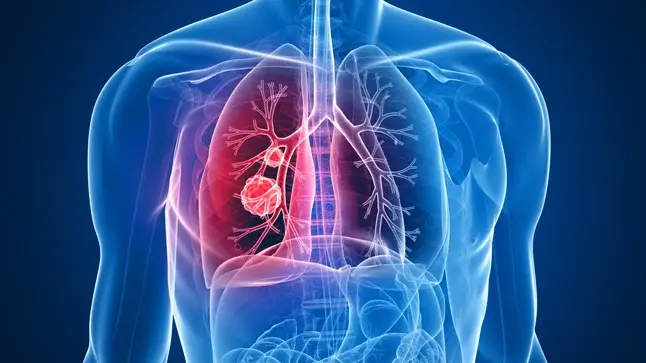 cancer-pulmon.webp
