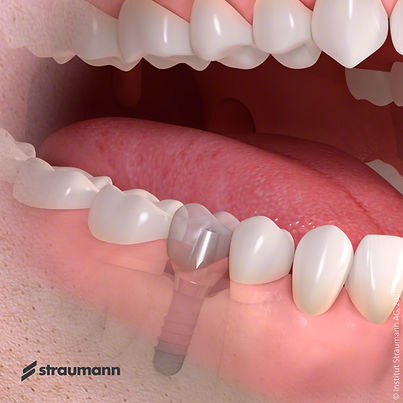 Implants for smaller gaps button image.png